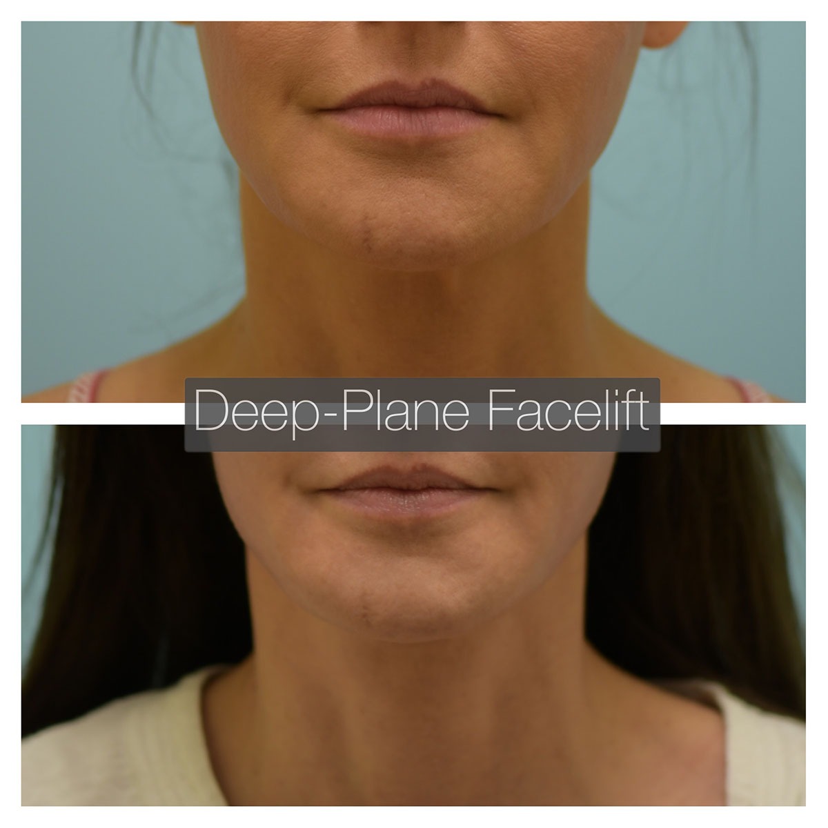 Deep Plane Facelift Before and After Photo by Dr. Lam in Plano, TX
