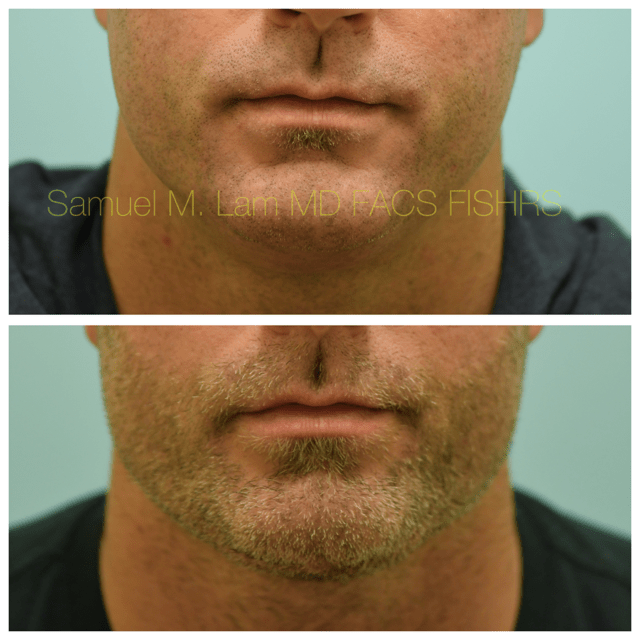 Facelift Before and After Photo by Dr. Lam in Plano, TX