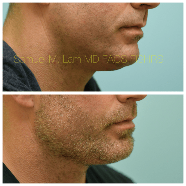 Facelift Before and After Photo by Dr. Lam in Plano, TX