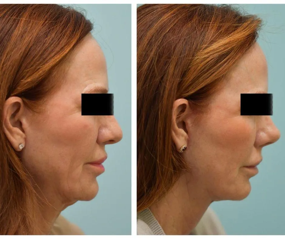 Facelift Before and After Photo by Dr. Lam in Plano TX