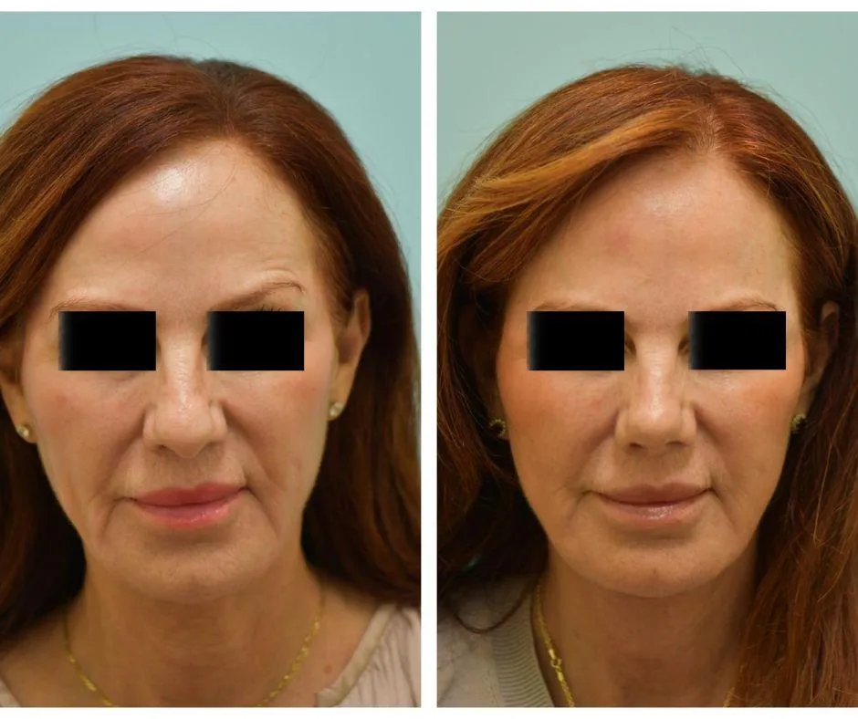 Facelift Before and After Photo by Dr. Lam in Plano TX
