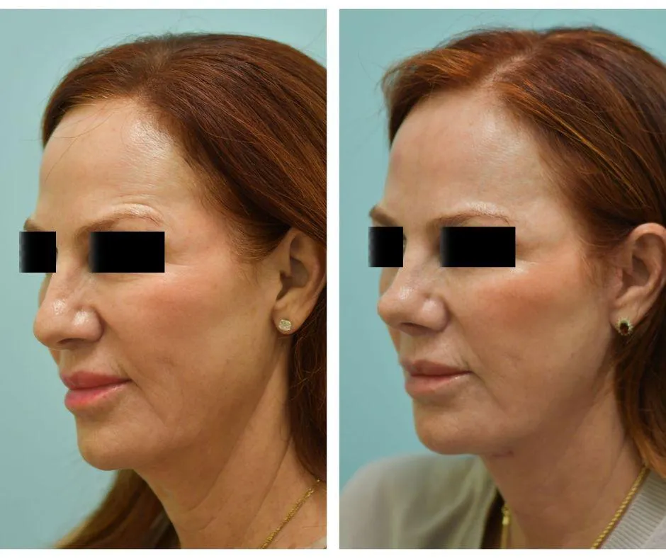 Facelift Before and After Photo by Dr. Lam in Plano TX