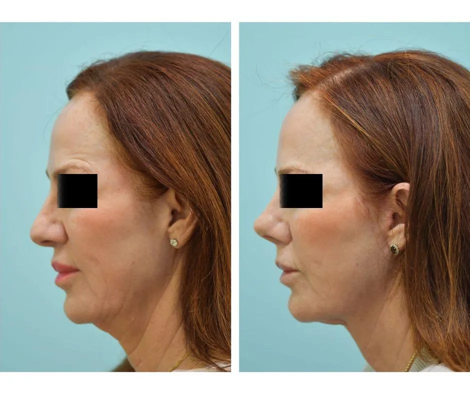 Facelift Before and After Photo by Dr. Lam in Plano TX