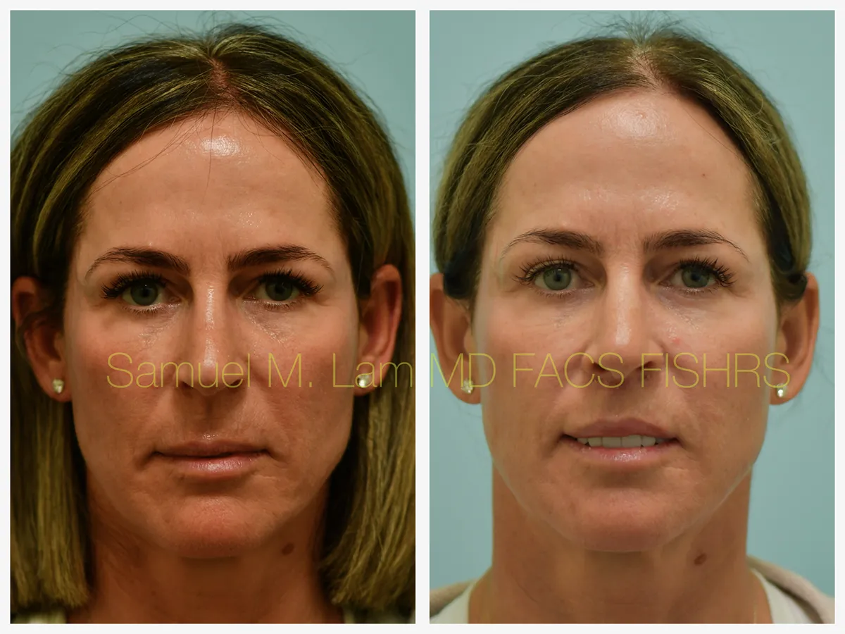 Lip Lift Before and After Photo by Dr. Lam in Plano, TX