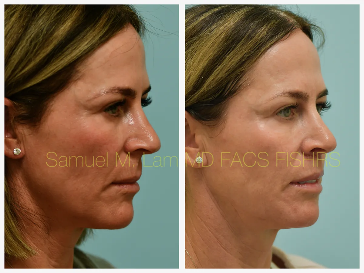 Lip Lift Before and After Photo by Dr. Lam in Plano, TX