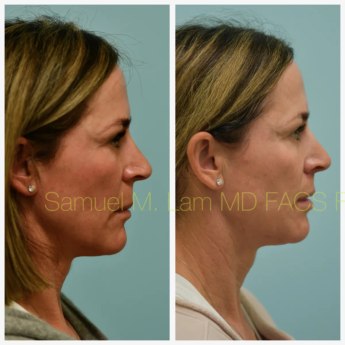 Lip Lift Before and After Photo by Dr. Lam in Plano, TX