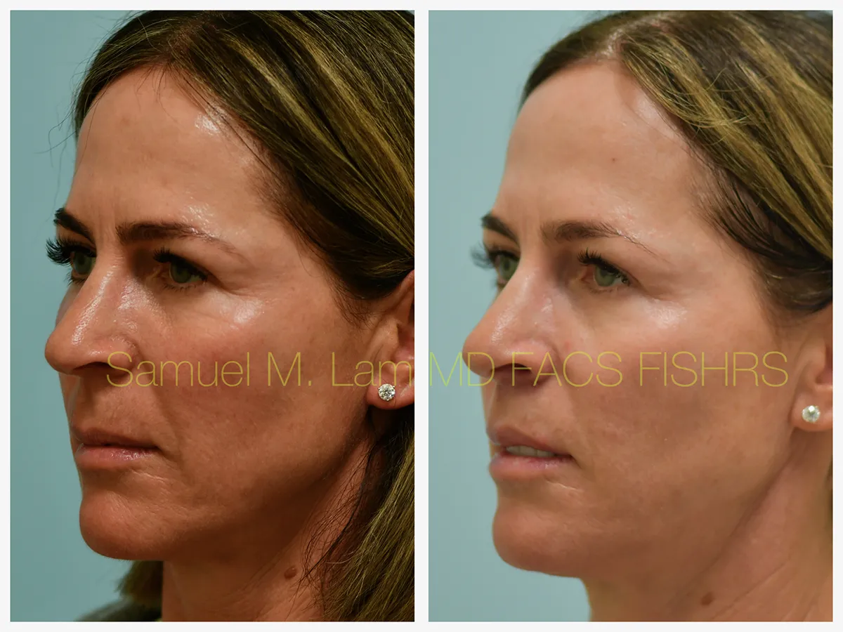 Lip Lift Before and After Photo by Dr. Lam in Plano, TX