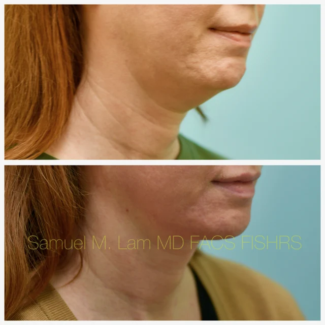 Facelift Before and After Photo by Dr. Lam in Plano TX