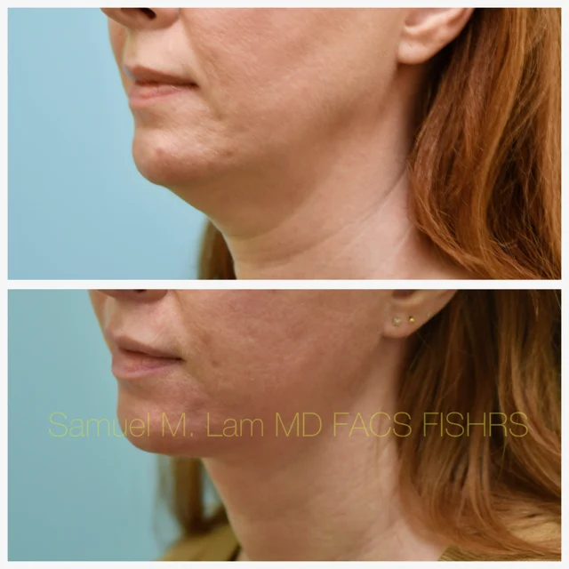 Facelift Before and After Photo by Dr. Lam in Plano TX