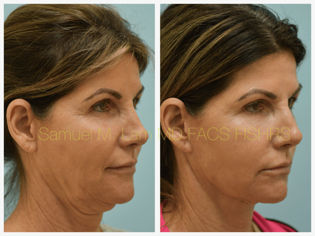 Fat Grafting and Facelift Before and After Photo by Dr. Lam in Plano, TX