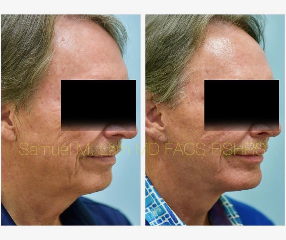 Facelift and Chin Implant Before and After Photo by Dr. Lam in Plano, TX