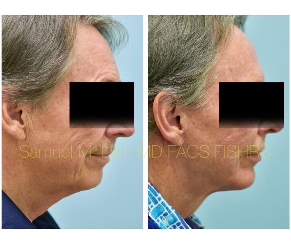 Facelift and Chin Implant Before and After Photo by Dr. Lam in Plano, TX
