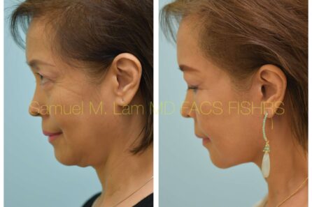 Facelift Before and After Photo by Dr. Lam in Plano TX of