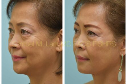 Facelift Before and After Photo by Dr. Lam in Plano TX f