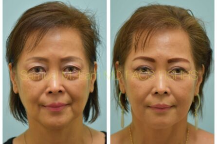 Facelift Before and After Photo by Dr. Lam in Plano TX of