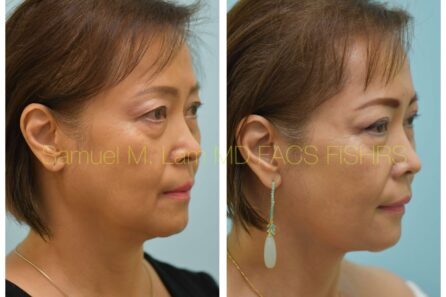 Facelift Before and After Photo by Dr. Lam in Plano TX of
