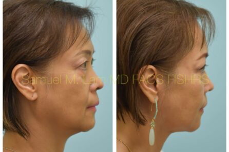 Facelift Before and After Photo by Dr. Lam in Plano TX of