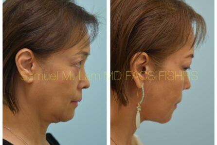 Facelift Before and After Photo by Dr. Lam in Plano TX of