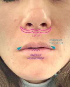 lip lift dallas