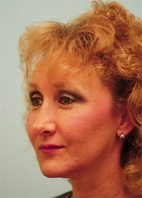facial_rejuvenation_tutorial_22