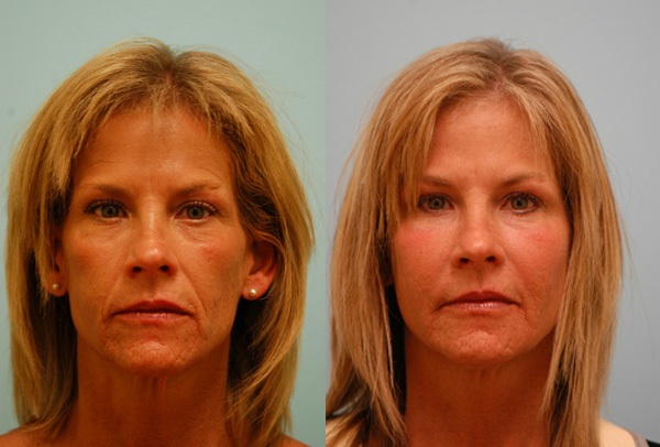 KIM FAT TRANSFER DALLAS TEXAS BEFORE AND AFTER