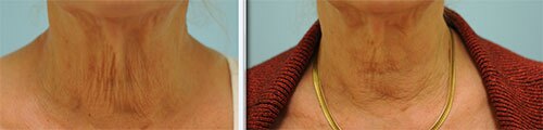 sculptra