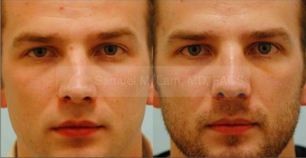 Crooked Nose Rhinoplasty Photos