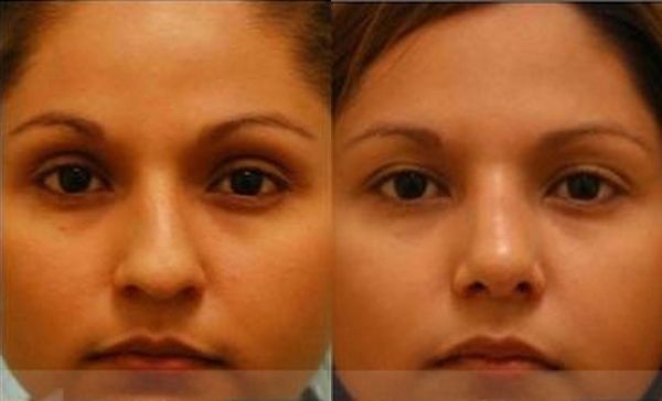 Crooked Nose Rhinoplasty Photos