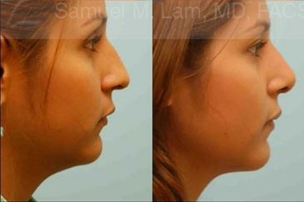 Crooked Nose Rhinoplasty Photos