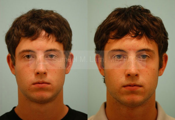 Crooked Nose Rhinoplasty Photos
