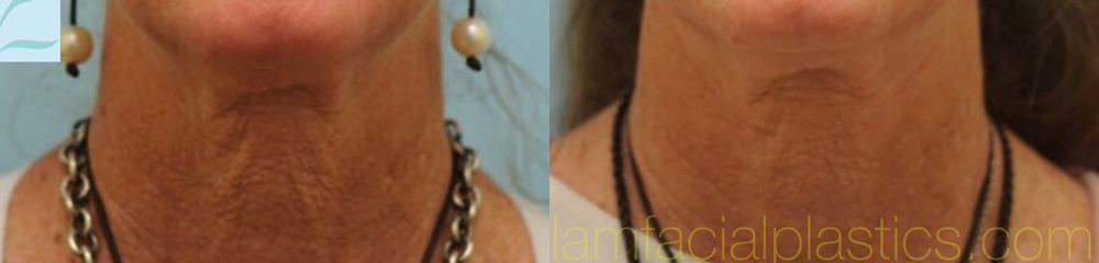 Sculptra Photos