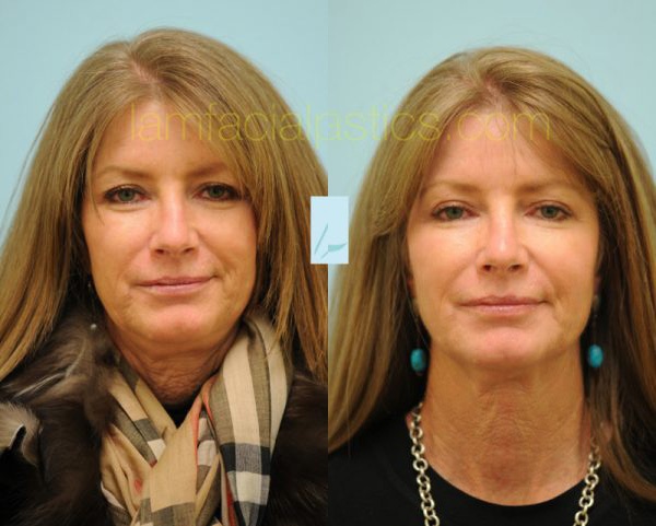 Sculptra Photos