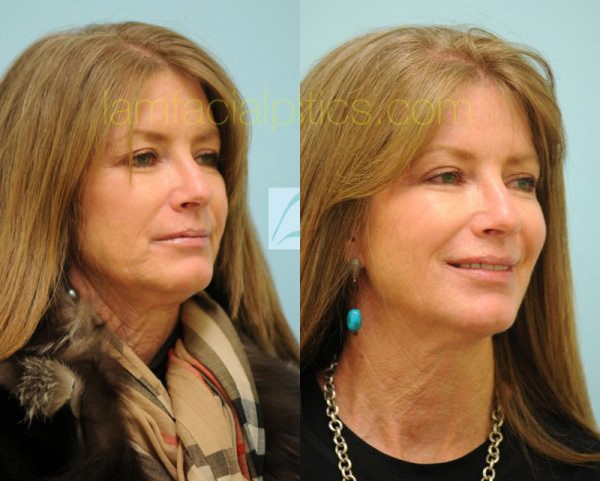 Sculptra Photos