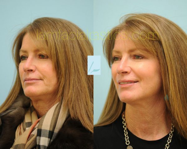 Sculptra Photos