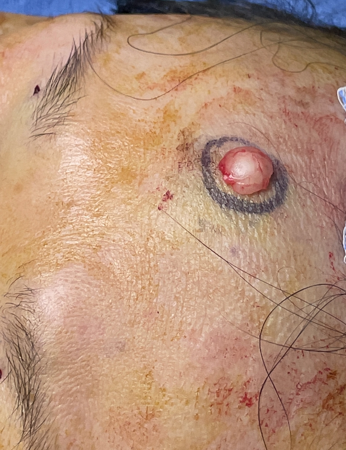 Osteoma Patient of Dr. Lam