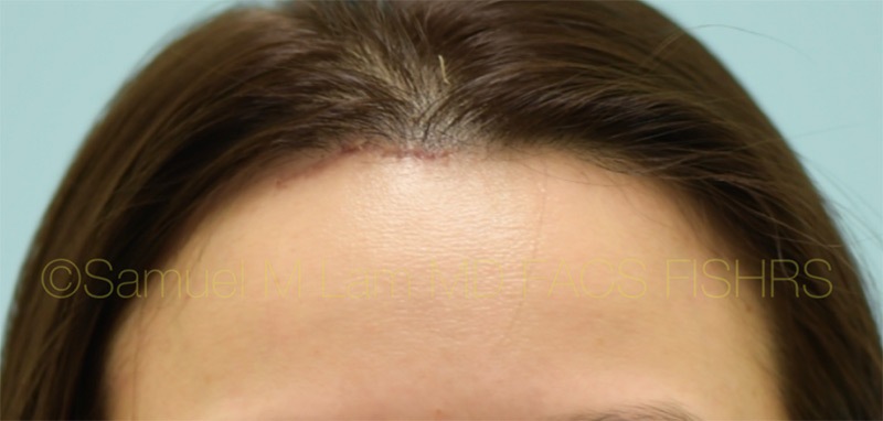 Osteoma Patient of Dr. Lam, After Procedure