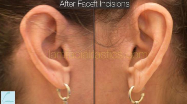 A woman who received a facelift in Dallas, TX