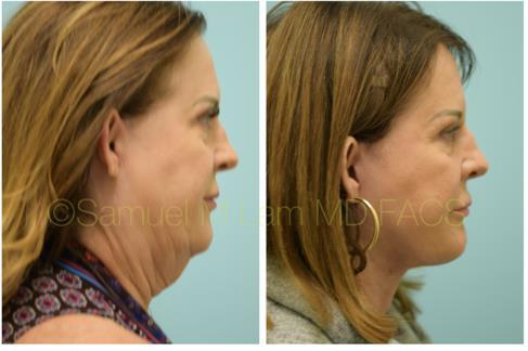 A woman who received a facelift in Dallas, TX