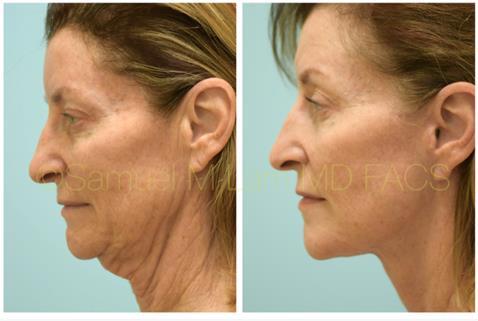 A woman who received a facelift in Dallas, TX