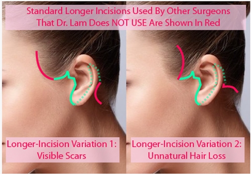 Longer Incision Variations