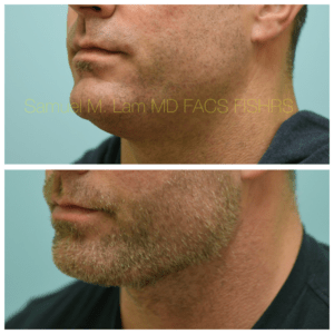 Facelift Before and After Photo by Dr. Lam in Plano, TX