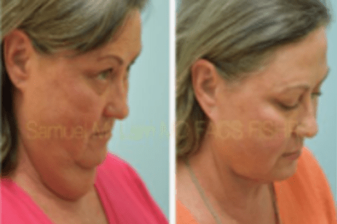 chin trim